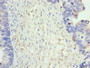 Immunohistochemistry of paraffin-embedded human ovarian cancer using CAC13846 at dilution of 1:100 Immunohistochemistry of paraffin-embedded human ovarian cancer using CAC13846 at dilution of 1:100