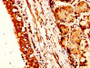 IHC image of CAC13848 diluted at 1:300 and staining in paraffin-embedded human lung cancer performed on a Leica BondTM system. After dewaxing and hydration, antigen retrieval was mediated by high pressure in a citrate buffer (pH 6.0). Section was blocked with 10% normal goat serum 30min at RT. Then primary antibody (1% BSA) was incubated at 4°C overnight. The primary is detected by a biotinylated secondary antibody and visualized using an HRP conjugated SP system.
