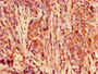Immunohistochemistry of paraffin-embedded human pancreatic cancer using CAC13874 at dilution of 1:100