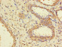 Immunohistochemistry of paraffin-embedded human prostate cancer using CAC13880 at dilution of 1:100