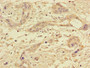 Immunohistochemistry of paraffin-embedded human pancreatic cancer using CAC13880 at dilution of 1:100