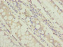 Immunohistochemistry of paraffin-embedded human colon cancer using CAC13954 at dilution of 1:100