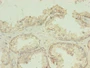 Immunohistochemistry of paraffin-embedded human prostate cancer using CAC13962 at dilution of 1:100
