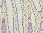 Immunohistochemistry of paraffin-embedded human colon cancer using CAC13965 at dilution of 1:100