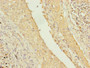 Immunohistochemistry of paraffin-embedded human lung cancer using CAC13971 at dilution of 1:100