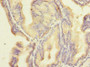 Immunohistochemistry of paraffin-embedded human prostate cancer using CAC14018 at dilution of 1:100 Immunohistochemistry of paraffin-embedded human prostate cancer using CAC14018 at dilution of 1:100