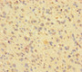 Immunohistochemistry of paraffin-embedded human glioma using CAC14038 at dilution of 1:100 Immunohistochemistry of paraffin-embedded human glioma using CAC14038 at dilution of 1:100