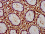 IHC image of CAC14042 diluted at 1:150 and staining in paraffin-embedded human gastric cancer performed on a Leica BondTM system. After dewaxing and hydration, antigen retrieval was mediated by high pressure in a citrate buffer (pH 6.0). Section was blocked with 10% normal goat serum 30min at RT. Then primary antibody (1% BSA) was incubated at 4°C overnight. The primary is detected by a biotinylated secondary antibody and visualized using an HRP conjugated SP system.