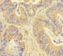 Immunohistochemistry of paraffin-embedded human colon cancer using CAC14071 at dilution of 1:100