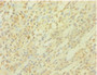 Immunohistochemistry of paraffin-embedded human breast cancer using CAC14078 at dilution of 1:100 Immunohistochemistry of paraffin-embedded human breast cancer using CAC14078 at dilution of 1:100