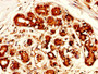 IHC image of CAC14119 diluted at 1:300 and staining in paraffin-embedded human breast cancer performed on a Leica BondTM system. After dewaxing and hydration, antigen retrieval was mediated by high pressure in a citrate buffer (pH 6.0). Section was blocked with 10% normal goat serum 30min at RT. Then primary antibody (1% BSA) was incubated at 4°C overnight. The primary is detected by a biotinylated secondary antibody and visualized using an HRP conjugated SP system.