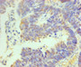 Immunohistochemistry of paraffin-embedded human ovarian cancer using CAC14128 at dilution of 1:100