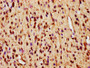 IHC image of CAC14179 diluted at 1:600 and staining in paraffin-embedded human glioma performed on a Leica BondTM system. After dewaxing and hydration, antigen retrieval was mediated by high pressure in a citrate buffer (pH 6.0). Section was blocked with 10% normal goat serum 30min at RT. Then primary antibody (1% BSA) was incubated at 4°C overnight. The primary is detected by a biotinylated secondary antibody and visualized using an HRP conjugated SP system.