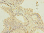 Immunohistochemistry of paraffin-embedded human prostate cancer using CAC14180 at dilution of 1:100
