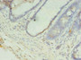 Immunohistochemistry of paraffin-embedded human colon cancer using CAC14196 at dilution of 1:100