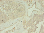 Immunohistochemistry of paraffin-embedded human endometrial cancer using CAC14197 at dilution of 1:100