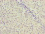 Immunohistochemistry of paraffin-embedded human liver cancer using CAC14212 at dilution of 1:100