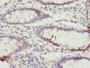 Immunohistochemistry of paraffin-embedded human colon cancer using CAC14215 at dilution of 1:100 Immunohistochemistry of paraffin-embedded human colon cancer using CAC14215 at dilution of 1:100