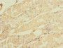 Immunohistochemistry of paraffin-embedded human gastric cancer using CAC14253 at dilution of 1:100 Immunohistochemistry of paraffin-embedded human gastric cancer using CAC14253 at dilution of 1:100