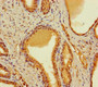 Immunohistochemistry of paraffin-embedded human prostate cancer using CAC14274 at dilution of 1:100