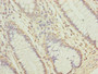 Immunohistochemistry of paraffin-embedded human colon cancer using CAC14286 at dilution of 1:100