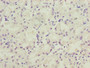 Immunohistochemistry of paraffin-embedded human gastric cancer using CAC14299 at dilution of 1:100 Immunohistochemistry of paraffin-embedded human gastric cancer using CAC14299 at dilution of 1:100