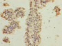 Immunohistochemistry of paraffin-embedded human breast cancer using CAC14310 at dilution of 1:100 Immunohistochemistry of paraffin-embedded human breast cancer using CAC14310 at dilution of 1:100