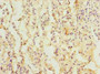 Immunohistochemistry of paraffin-embedded human lung cancer using CAC14336 at dilution of 1:100 Immunohistochemistry of paraffin-embedded human lung cancer using CAC14336 at dilution of 1:100