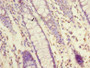 Immunohistochemistry of paraffin-embedded human colon cancer using CAC14340 at dilution of 1:100