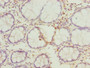 Immunohistochemistry of paraffin-embedded human colon cancer using CAC14351 at dilution of 1:100 Immunohistochemistry of paraffin-embedded human colon cancer using CAC14351 at dilution of 1:100