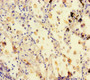 Immunohistochemistry of paraffin-embedded human lung cancer using CAC14357 at dilution of 1:100 Immunohistochemistry of paraffin-embedded human lung cancer using CAC14357 at dilution of 1:100