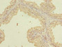 Immunohistochemistry of paraffin-embedded human prostate cancer using CAC14366 at dilution of 1:100 Immunohistochemistry of paraffin-embedded human prostate cancer using CAC14366 at dilution of 1:100