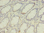 Immunohistochemistry of paraffin-embedded human colon cancer using CAC14381 at dilution of 1:100