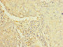 Immunohistochemistry of paraffin-embedded human lung cancer using CAC14391 at dilution of 1:100 Immunohistochemistry of paraffin-embedded human lung cancer using CAC14391 at dilution of 1:100
