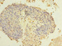 Immunohistochemistry of paraffin-embedded human cervical cancer using CAC14415 at dilution of 1:100