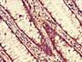 Immunohistochemistry of paraffin-embedded human colon cancer using CAC14430 at dilution of 1:100 Immunohistochemistry of paraffin-embedded human colon cancer using CAC14430 at dilution of 1:100