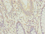 Immunohistochemistry of paraffin-embedded human colon cancer using CAC14437 at dilution of 1:100 Immunohistochemistry of paraffin-embedded human colon cancer using CAC14437 at dilution of 1:100