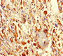 Immunohistochemistry of paraffin-embedded human melanoma using CAC14438 at dilution of 1:100