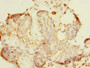 Immunohistochemistry of paraffin-embedded human breast cancer using CAC14452 at dilution of 1:100 Immunohistochemistry of paraffin-embedded human breast cancer using CAC14452 at dilution of 1:100