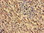 Immunohistochemistry analysis of human liver cancer using CAC14480 at dilution of 1:100