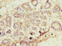 Immunohistochemistry of paraffin-embedded human breast cancer using CAC14503 at dilution of 1:100
