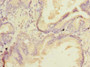 Immunohistochemistry of paraffin-embedded human prostate cancer using CAC14505 at dilution of 1:100