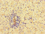 Immunohistochemistry of paraffin-embedded human liver cancer using CAC14526 at dilution of 1:100