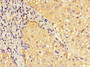 Immunohistochemistry of paraffin-embedded human liver cancer using CAC14531 at dilution of 1:100 Immunohistochemistry of paraffin-embedded human liver cancer using CAC14531 at dilution of 1:100