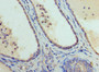 Immunohistochemistry of paraffin-embedded human prostate cancer using CAC14535 at dilution of 1:100 Immunohistochemistry of paraffin-embedded human prostate cancer using CAC14535 at dilution of 1:100