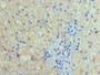 Immunohistochemistry of paraffin-embedded human liver cancer using CAC14537 at dilution of 1:100 Immunohistochemistry of paraffin-embedded human liver cancer using CAC14537 at dilution of 1:100