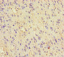 Immunohistochemistry of paraffin-embedded human glioma using CAC14543 at dilution of 1:100 Immunohistochemistry of paraffin-embedded human glioma using CAC14543 at dilution of 1:100
