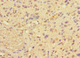 Immunohistochemistry of paraffin-embedded human glioma using CAC14545 at dilution of 1:100 Immunohistochemistry of paraffin-embedded human glioma using CAC14545 at dilution of 1:100