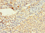 Immunohistochemistry of paraffin-embedded human lung cancer using CAC14554 at dilution of 1:100 Immunohistochemistry of paraffin-embedded human lung cancer using CAC14554 at dilution of 1:100