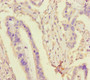 Immunohistochemistry of paraffin-embedded human pancreatic cancer using CAC14570 at dilution of 1:100 Immunohistochemistry of paraffin-embedded human pancreatic cancer using CAC14570 at dilution of 1:100